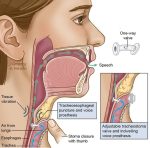 blom singer elektrolarengs konuşma cihazı made in usa ( ses protezleri ) - Görsel 2